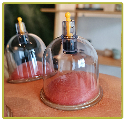 Cupping